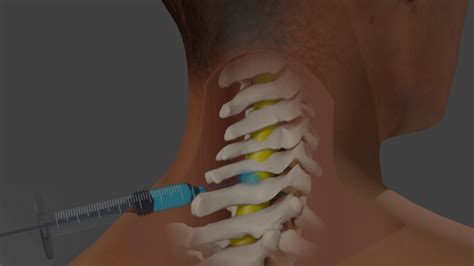 Cervical Epidural Injection In Neck