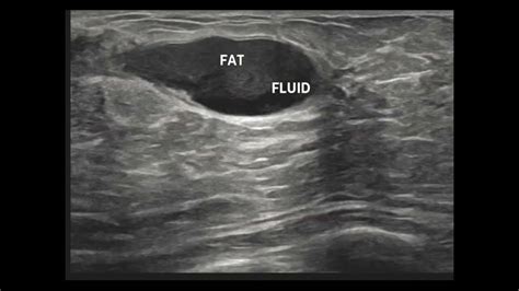 Differentiating Breast Abscess and Galactocele on Ultrasound with practical tips - YouTube