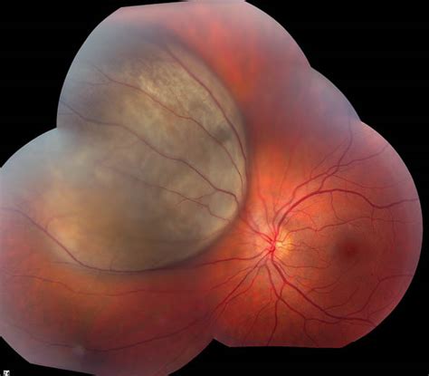 Melanoma, choroidal. Causes, symptoms, treatment Melanoma, choroidal