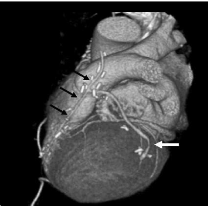 The left internal thoracic artery graft (black arrows) is connected to... | Download Scientific ...