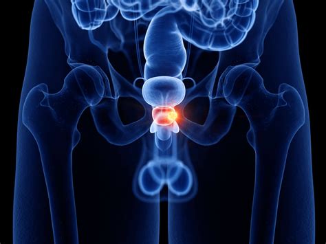 Causes and prevention of prostatitis