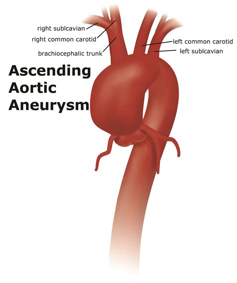 Thoracic Aortic Aneurysm | UF Health Aortic Disease Center|Diseases ...