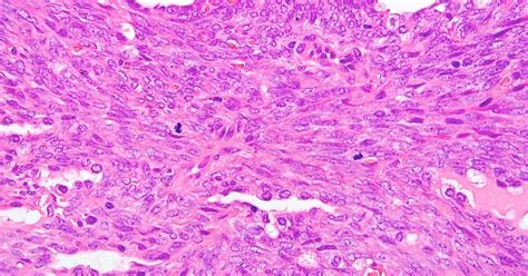 Synovial Sarcoma, What Is It, Causes, Symptoms, Treatment, Complete Guide 2023