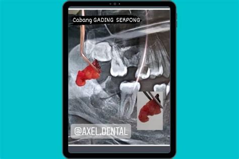 Operasi Gigi Bungsu | Services - Axel Dental