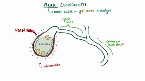 Chronic cholecystitis: Video, Anatomy & Definition | Osmosis