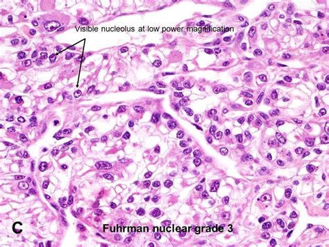 American Urological Association - Clear Cell Renal Cell Carcinoma ...