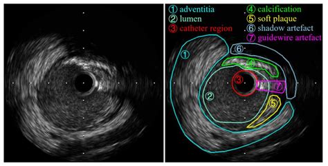 Applied Sciences | Free Full-Text | IVUS Image Segmentation Using ...