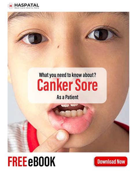 How canker sore can affect your health? Haspatal online doctor consultation app. - Haspatal｜Easy ...