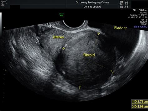 Uterine fibroid (leiomyoma) - HKOG-INFO