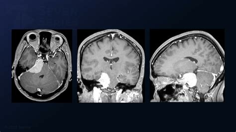 #90: Supratentorial-Infraoccipital Approach for Resection of a Posteromedial Temporal AVM in a ...