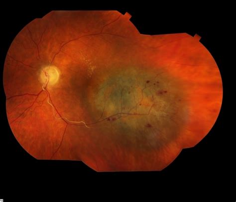 Malignant Choroidal Melanoma - Retina Image Bank