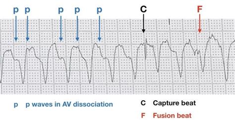 Pin on ECG