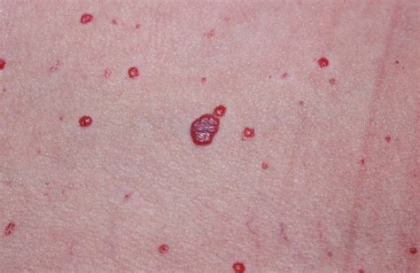 Hemangioma - Hemangioma Of Skin, Spine, Liver - Causes & Treatment