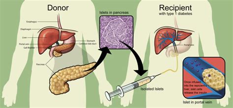 Islet cell transplantation - wikidoc