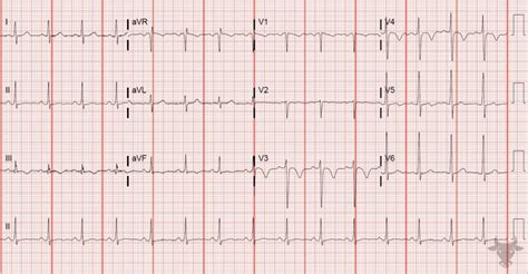 Right Heart Strain | ECG Stampede