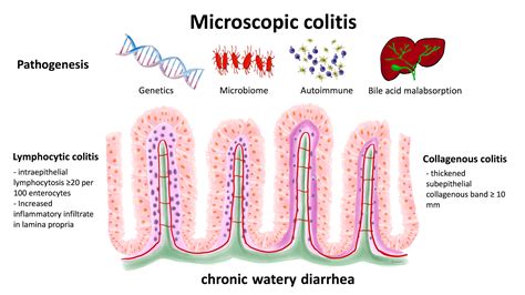 JCM | Free Full-Text | Microscopic Colitis: Pathogenesis and Diagnosis