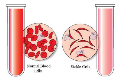 Pediatrics Notes: Diagnosis of Sickle Cell Disease