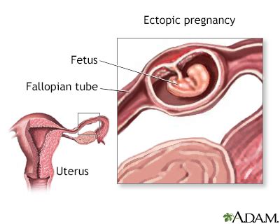 Ectopic Pregnancy Symptoms, Doctors, Treatments, Advances & More | MediFind