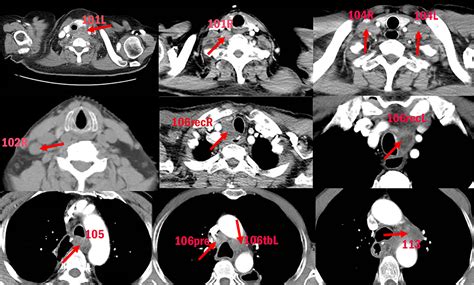 Frontiers | Mapping of Cervical and Upper Mediastinal Lymph Node Recurrence for Guiding Clinical ...