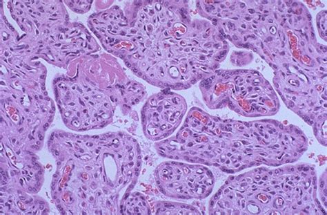 Pathology Outlines - Placental development