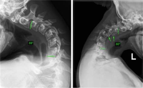 An unusual cause of cervical kyphosis - The Spine Journal