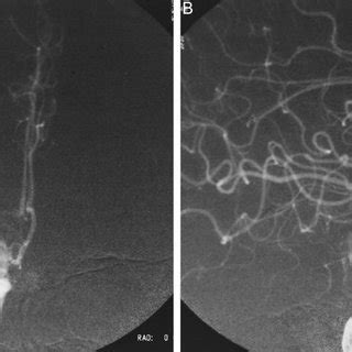 Preoperative right internal carotid artery angiogram, anteroposterior ...