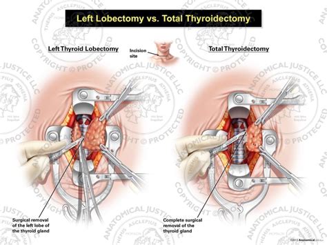 Female Left Lobectomy vs. Total Thyroidectomy