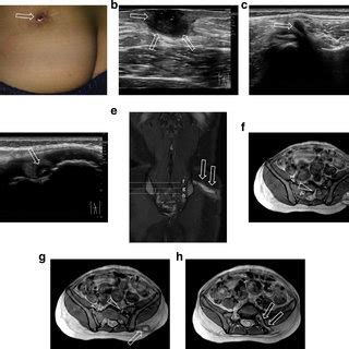 (PDF) Image findings of dermal sinus in the lateral buttocks