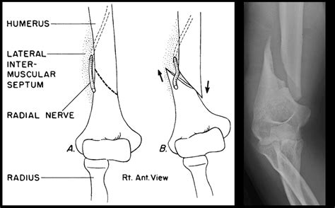 Holstein–Lewis fracture • LITFL • Medical Eponym Library