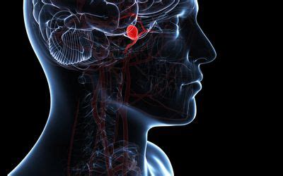 Damage to the Corona Radiata After Stroke