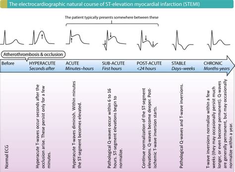 ST segment elevation in acute myocardial ischemia and differential diagnoses – ECG learning