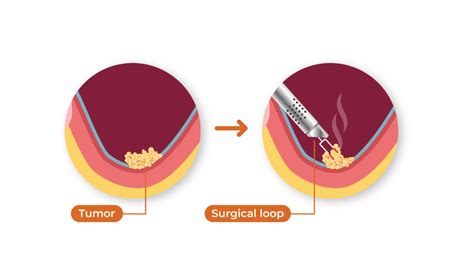 Understanding TURBT: Bladder Tumor Removal Surgery | BCAN