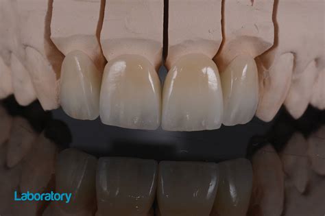 Incisal edge design on lithium disilicate crowns - Dentistry