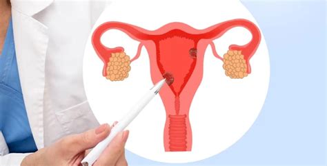 Endometrial Cancer : Causes, Symptoms, and Treatments | Dr Praveen Kammar