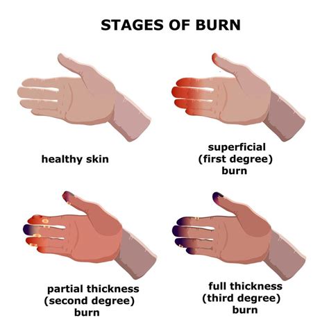 ilustração vetorial médica. estágios de queima. queimaduras de grau da ...