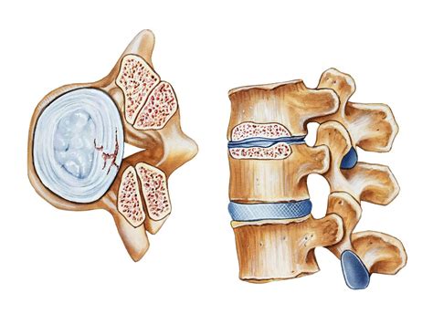 Spinal Stenosis Mri