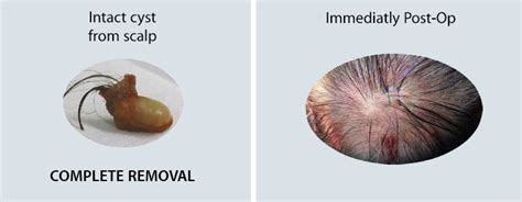 Sebaceous Cyst Scalp Removal