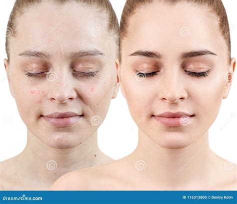 Woman with Acne before and after Treatment and Make-up. Stock Photo ...