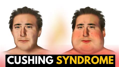 What are three or four symptoms of Cushing syndrome? What are three ...