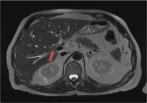 MRI image (T2 sequence) showing a 2.3 ? 2.2 cm infiltrative lesion at... | Download Scientific ...