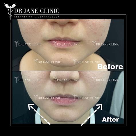 Face V Shaping: Achieve a Youthful and Sculpted Facial Profile | Dr Jane Clinic