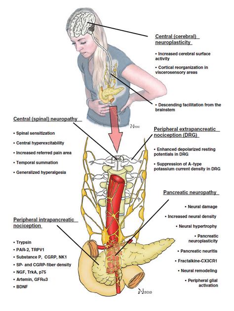 The main causes of pain in chronic pancreatitis. Neuropathic pain in... | Download Scientific ...