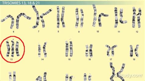 What Is Trisomy? - Definition & Symptoms - Lesson | Study.com