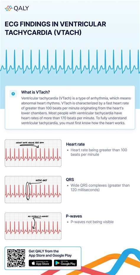 Ventricular Tachycardia Ecg