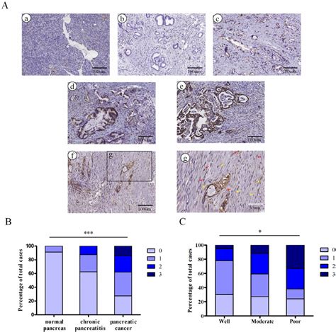 The embryonic protein Nodal is expressed in pancreatic ductal ...