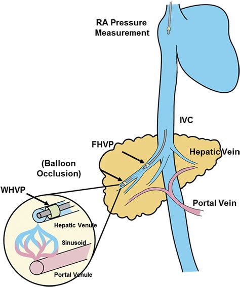 Portal Hypertension and Related Complications: Diagnosis and Management ...