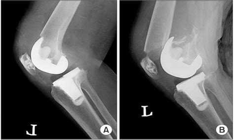 Figure 2 from PERIPROSTHETIC FRACTURE FOLLOWING TOTAL KNEE ARTHROPLASTY ...