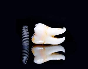 Zygomatic implants are dental implants | Arch Dental