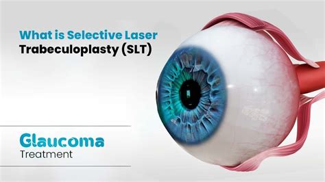 What is Selective Laser Trabeculoplasty (SLT) | Glaucoma Treatment (3D ...