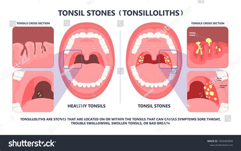 Palatine Tonsils: Over 127 Royalty-Free Licensable Stock Vectors & Vector Art | Shutterstock